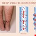  DVT