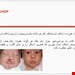 دانلود پاورپوینت پرستاری درمورد شکاف لب یا لب شکری  