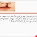  دانلود پاورپوینت پرستاری درمورد شکاف لب یا لب شکری 