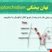  دانلود پاورپوینت تخصصی پرستاری در مورد نهان بیضگی Cryptorchidism 