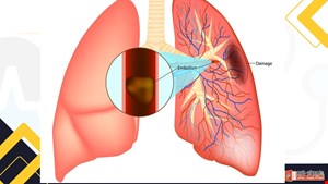 دانلود پاورپوینت پرستاری درمورد آمبولی ریه Pulmonary Embolism (PE)