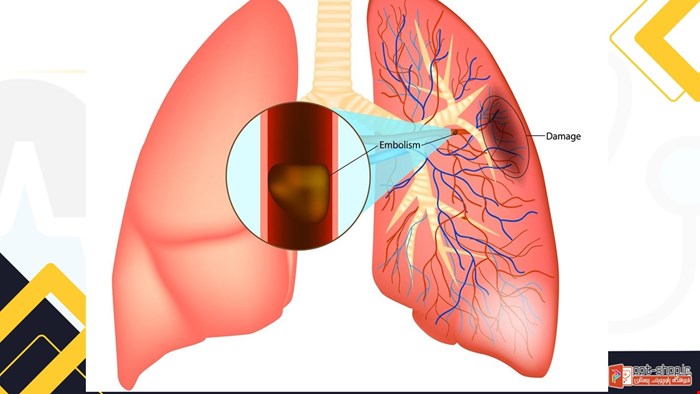 دانلود پاورپوینت پرستاری درمورد آمبولی ریه Pulmonary Embolism (PE)