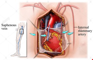 دانلود پاورپوینت تخصصی پرستاری در مورد مراقبت های پرستاری بیمار CABG (پیوند عروق کرونر قلب )