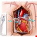 CABG پیوند عروق کرونر قلب 