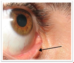 دانلود پاورپوینت پرستاری درمورد روش های تشخیصی بیماری های چشم (ارزشیابی تشخیصی )