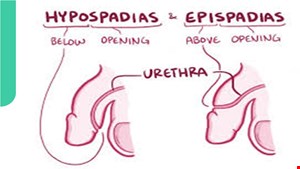 دانلود پاورپوینت پرستاری اپیسپادیاس و اکستروفی مثانه 