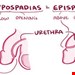 Epispadias/Exstrophy 