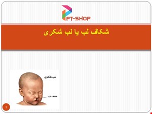 دانلود پاورپوینت پرستاری درمورد شکاف لب یا لب شکری 